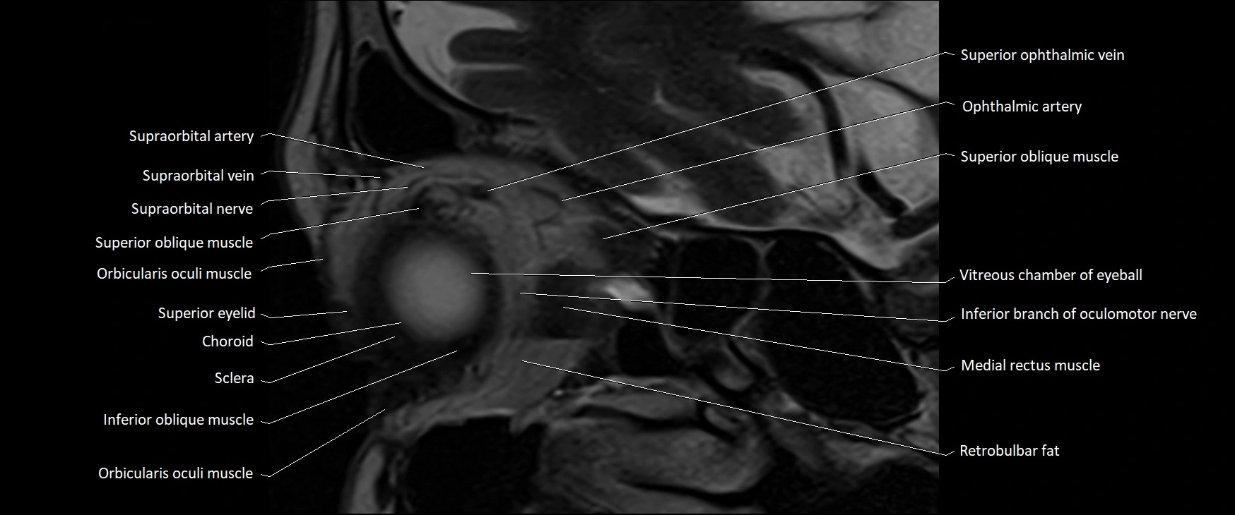 MRI Orbit sagittal cross sectional anatomy 3T image 5.webp